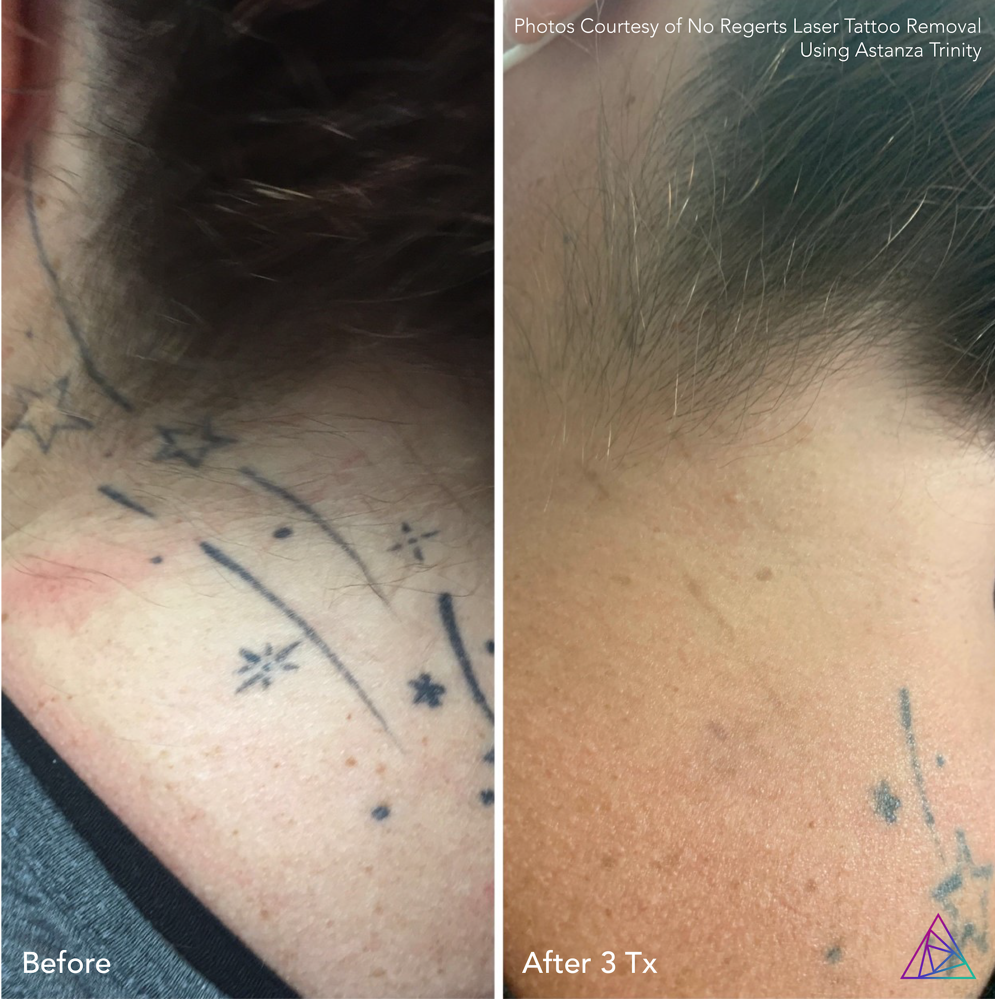 Before and after tattoo removal